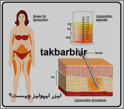 ليزر ليپوليز چیست؟