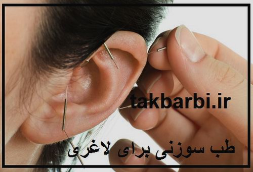 آیا طب سوزنی برای کاهش وزن مفید است