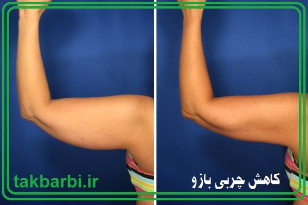 کاهش چربی بازو