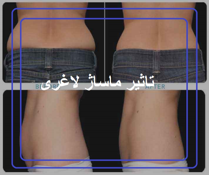 تاثیر ماساژ لاغری