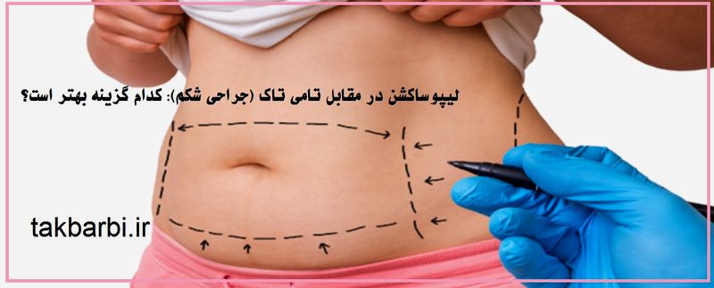 تفاوت لیپوساکشن و ابدومینوپلاستی