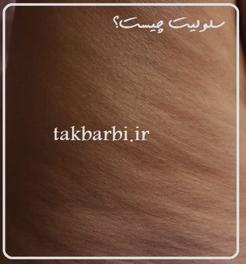 سلولیت به چه معناست