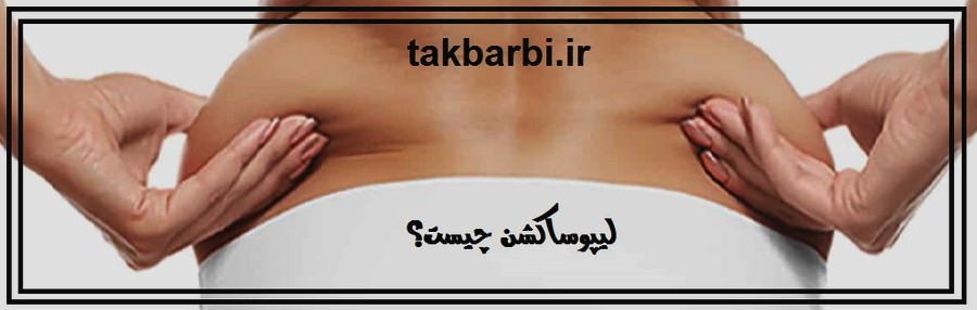 لیپوساکشن چیست ؟