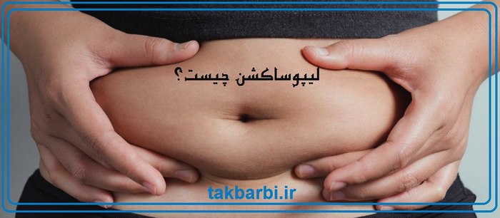 لیپوساکشن چیست ؟