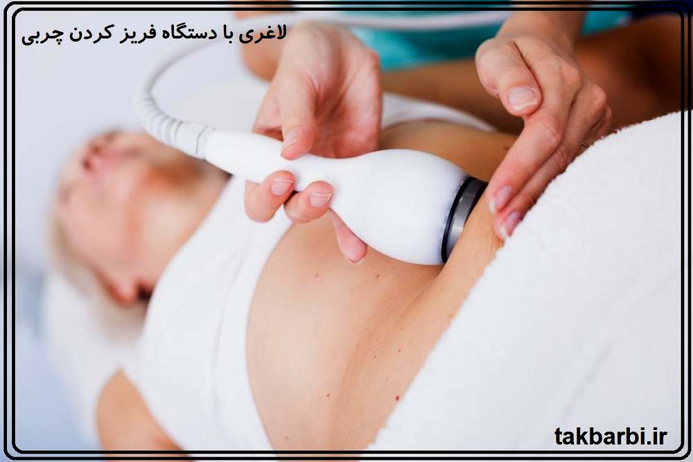  کرایولیپولیز