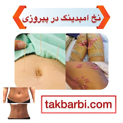 لاغری با نخ امبدینگ در پیروزی