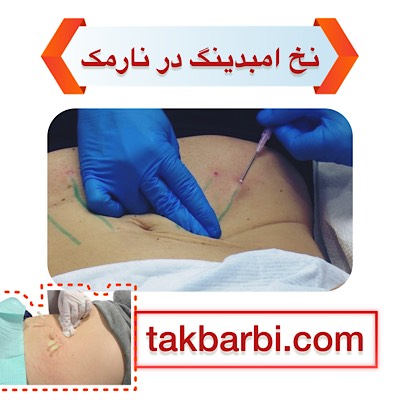 لاغری با نخ امبدینگ در نارمک