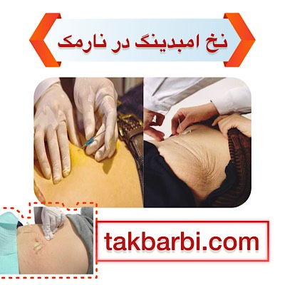 لاغری با نخ امبدینگ در نارمک