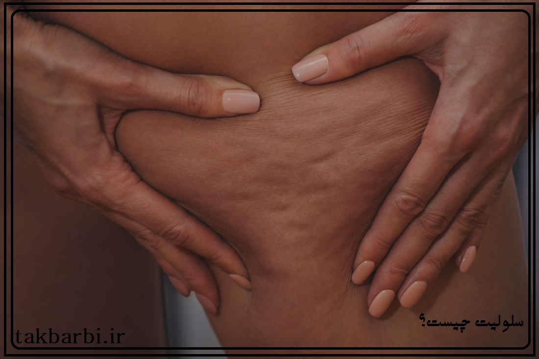 سلولیت روی پوست